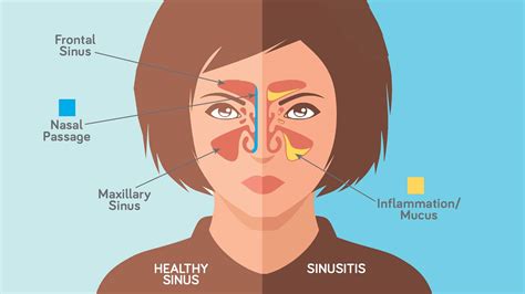 Runny Nose 3 Common Sinus Conditions To Know