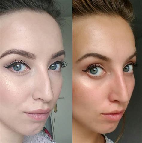 How My Non Surgical Nose Job Changed My Life Bles Magazine Beauty