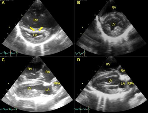 Right Parasternal Short Axis Echocardiographic Images Of Lv And Rv And