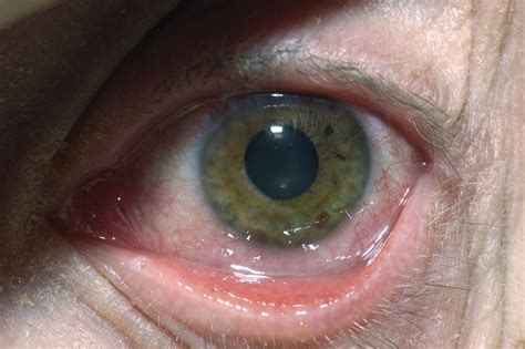 Herpes Simplex Eye Infections Nhs