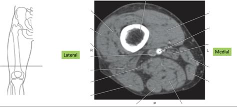 Axial Ct Of Right Distal Femur Axial Mri Of Left Tibia Axial Mri Of