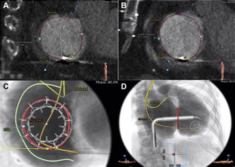 Transfemoral Transcatheter Tricuspid Valve Replacement With The Evoque
