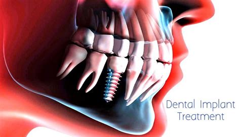 should you get a dental implant treatment 4 common stories that patients tell themselves