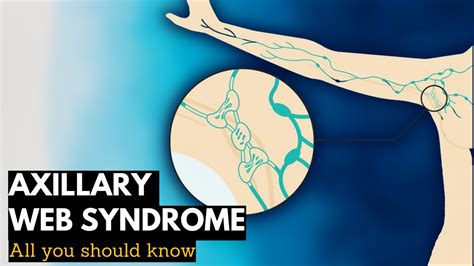 Axillary Web Syndrome Everything You Need To Know YouTube
