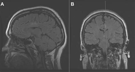Cingulate Gyrus Epilepsy Practical Neurology