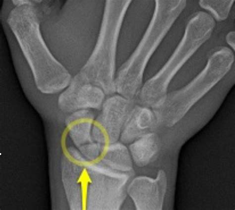 Scaphoid Navicular Fractures Dr Groh