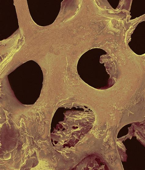 Cancellous Bone Tissue Photograph By Dennis Kunkel Microscopyscience
