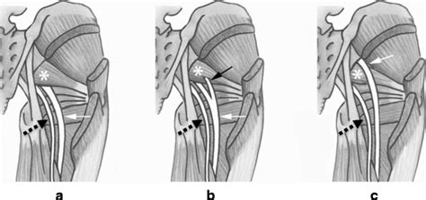 Post Operative Extra Spinal Etiologies Of Sciatic Nerve Impingement