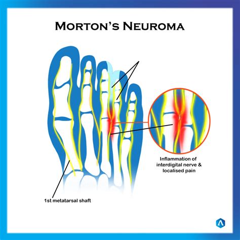 Mortons Neuroma Dr Abbie Clinics