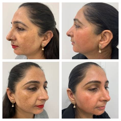 Hyperpigmentation Treatment Toronto Laser Resurfacing Mississauga