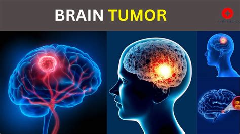 What Happens In Brain Tumor Symptoms And Causes Youtube