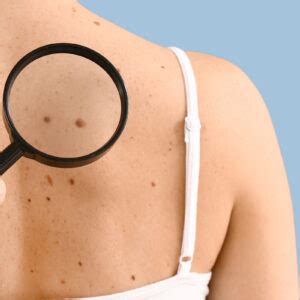 The Facts About Melanoma Dermphysicians Of New England