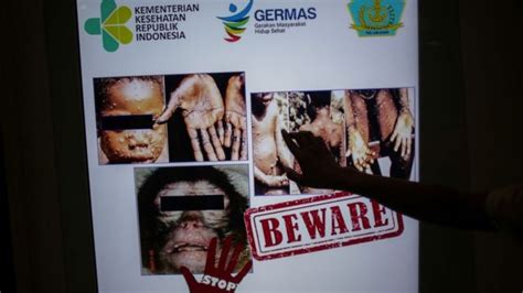 Cacar Monyet Ditemukan Di Singapura Seberapa Berbahaya Penyakit Tersebut Bbc News Indonesia