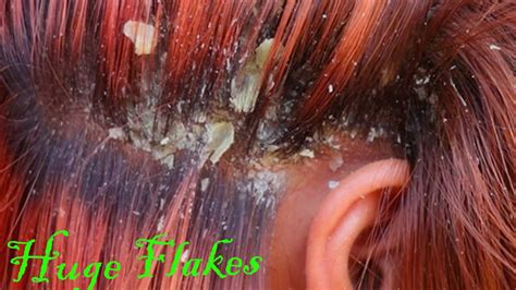scalp psoriasis vs dandruff scratching scalp psoriasis dandruff picking and causes