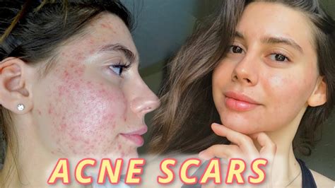 My Secrets To Heal Acne Scars Fast Struggling With Pigmentation Youtube