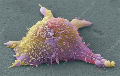 Skin Cancer Cell Sem Stock Image C0288619 Science Photo Library