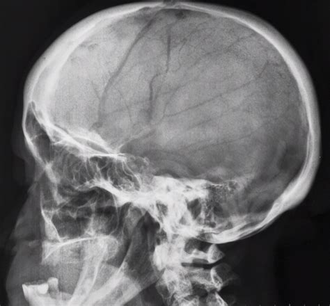 Lecture on x ray skull (a/p view). NORMAL FETAL SKULL (28 WEEKS) | buyxraysonline