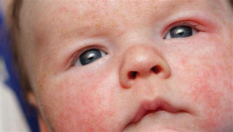 Tipos de Alergia alimentar no bebê como identificar sintomas e tratar