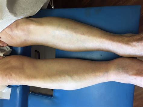 Leg Swelling Before And After Photos Following The Placement Of An