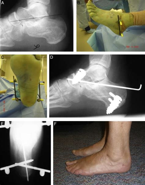 Technique For Minimally Invasive Reduction Of Calcaneal Fractures Using Small Bilateral External