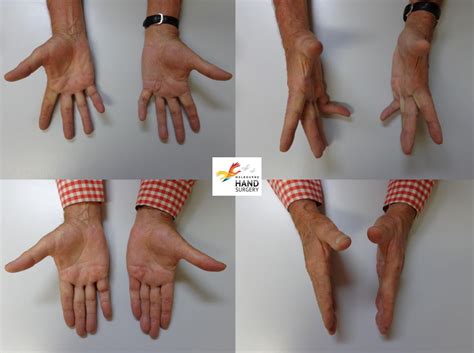 Needle Aponeurotomy Melbourne Hand Surgery