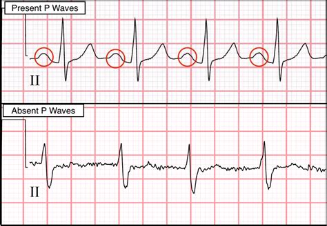 Electrocardiograms Ekgsecgs Evaluating P Waves Stepwards