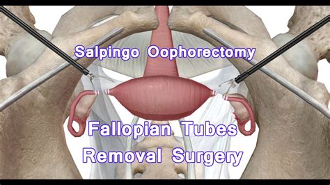 Laparoscopic Bilateral Ovary Removal Procedure Salpingo Oophorectomy