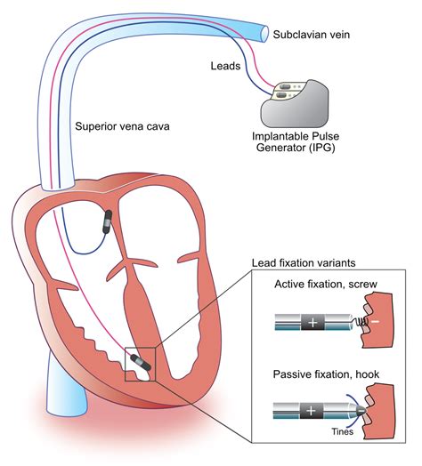 Components And Construction Of A Pacemaker Cardiovascular Education