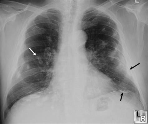 Examination, but the radiographic findings are malignant pleural mesothelioma (mpm) is the most frequent primary neoplasm of the pleura. Pleural calcification, asbestos exposure. White arrow ...
