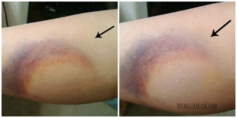 How To Bruise Yourself With Stage Makeup — Asl Rochelle