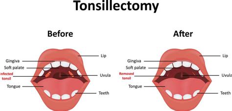 Tonsillectomy Sutton Place Dental Associates