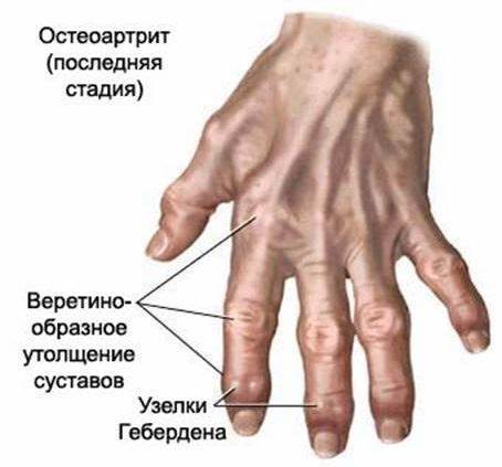 Диета при ревматоидный полиартрит