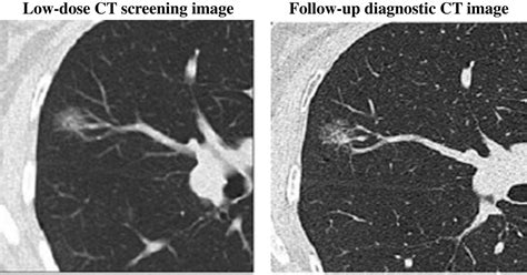 Low Dose Ct Scan Screening For Lung Cancer Comparison Of
