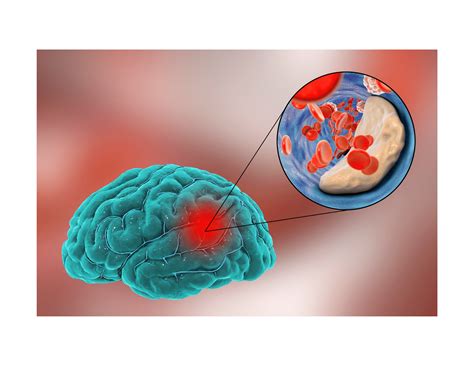 Cerebral Small Vessel Disease More Common Than You Think