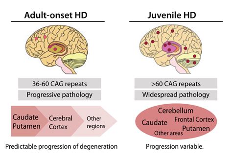 Study Identifies Previously Unknown Proteins In Huntingtons Disease