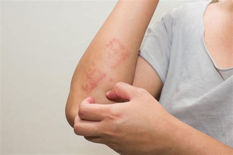Heres All That You Need To Know About Scabies Skin Rash Resultsdigest Com