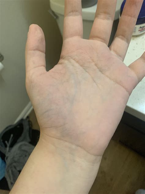 Strangely Visible Veins In My Hand Am I Dehydrated Or Do I Need To See