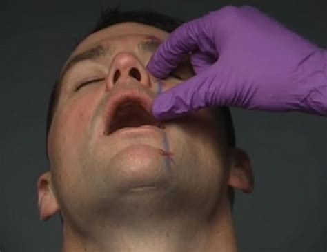 Nerve Blocks Of The Face And Mouth — Downeast Emergency Medicine