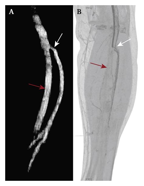 Comparison Between Below Knee Contrast Enhanced Tomographic 3d