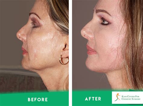 What Is The Importance Of Compression After Facelift Surgery Tampa