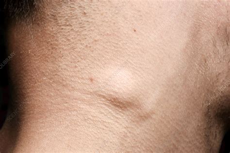 Swollen Lymph Nodes In Neck Causes And Treatment