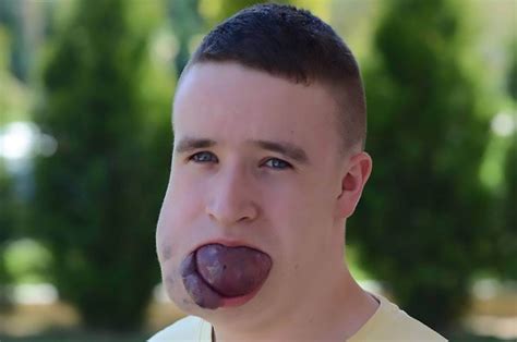 Teenager With Tennis Ball Sized Tongue Fears Death Every Night Daily Star