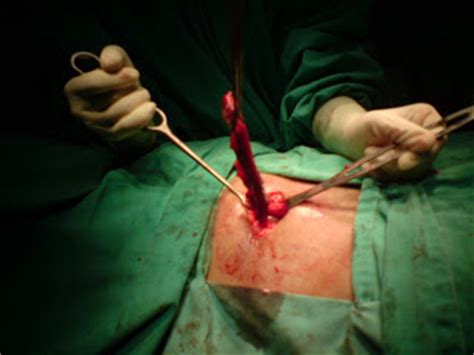 Introduced the modified lanz incision, which provides cosmetic scar and better. JAMES BOND MALAYA, MD: Appendicectomy