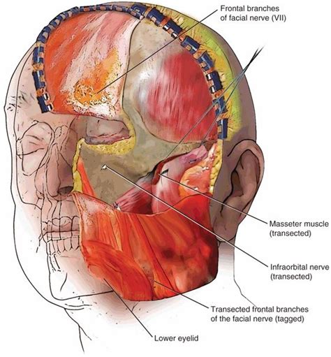 Facial Translocation Approach To The Central Cranial Base Ento Key
