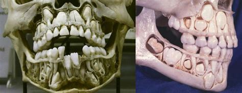 Dental Anatomy Dentaltown Human Skull Create Website Healthcare
