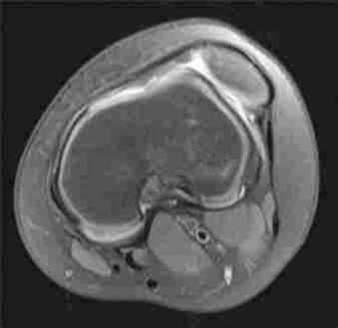 Magnetic Resonance Imaging Of The Left Knee Download Scientific Diagram