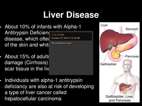 Cirrhosis and liver failure is commonly caused by alcohol, chronic. Alpha-1 Antitrypsin Deficiency
