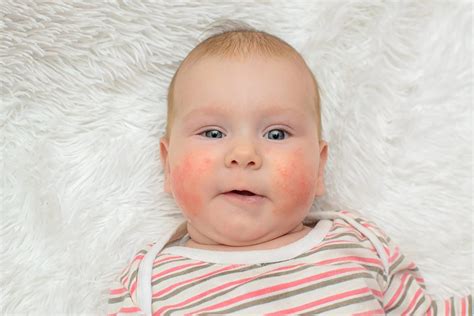 Common Skin Rashes In Children