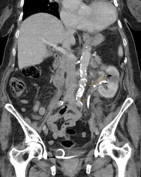 Ct Abdomen And Pelvis Coronal View Showing Pnct Yellow Arrows