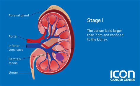 Kidney Cancer — Icon Cancer Centre Singapore